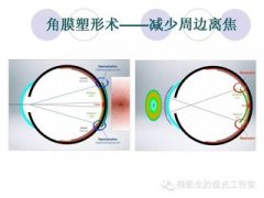 角膜塑形镜控制近视的原理